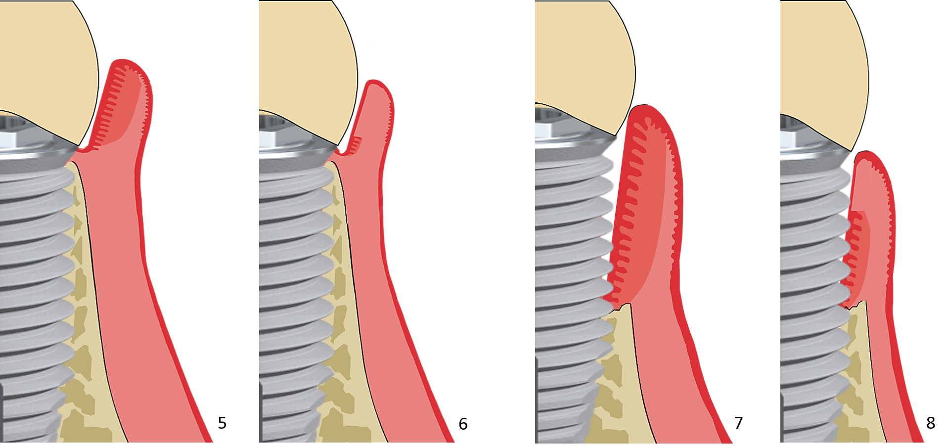 badminton bruiloft Aanhankelijk wat een tandvleesontsteking bij implantaten is en hoe dit behandeld wordt